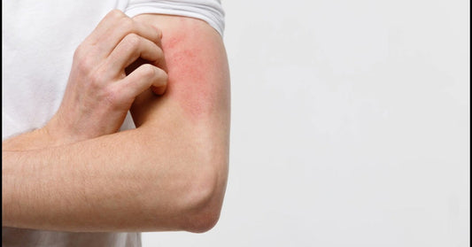 What Psoriasis Is, Symptoms, Causes, Types & Treatment