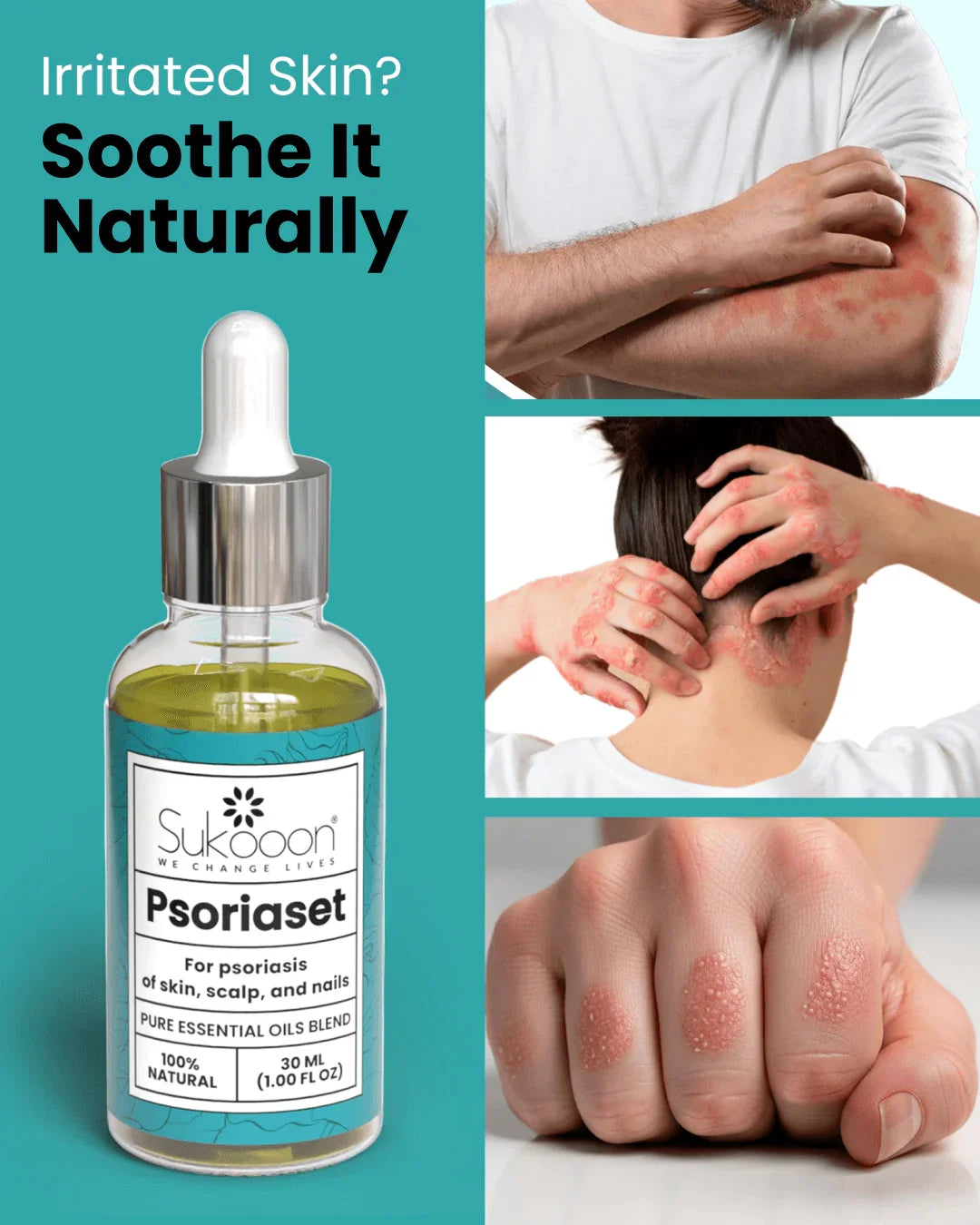 Natural psoriasis relief oil for skin, scalp & nails — soothe irritated skin with pure essential oils blend