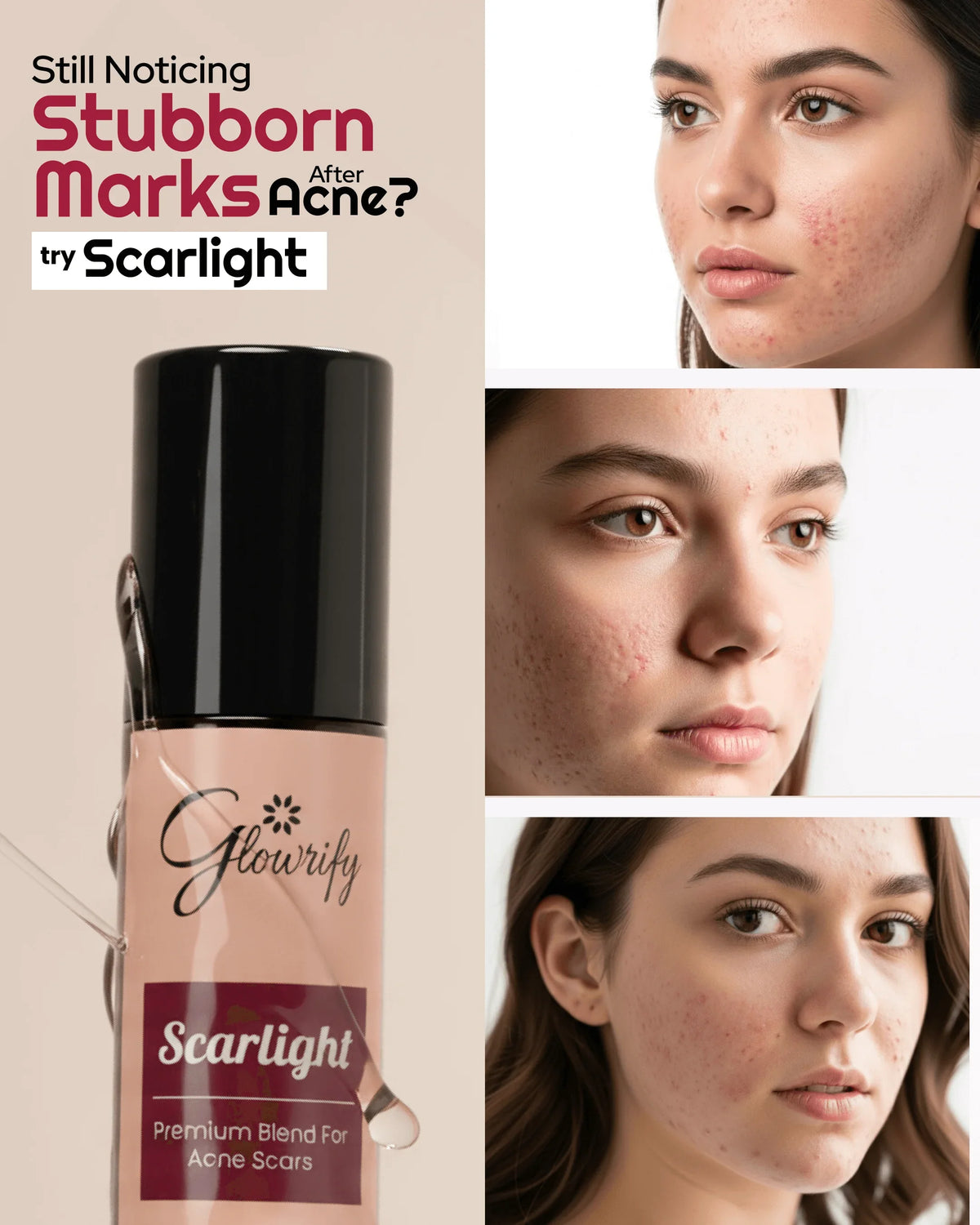 Scarlight premium blend for acne scars, natural skincare solution for stubborn marks after acne